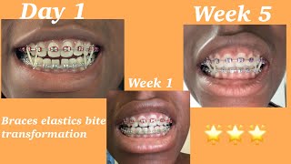 5 weeks of consistent braces elastics usage [upl. by Amati575]