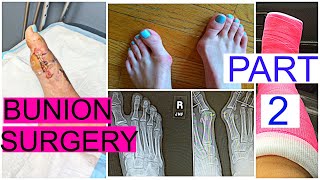 BUNION SURGERY PART 2  STORYTIME  Grace Jennings [upl. by Giles]