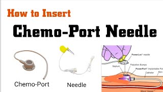 How to insert ChemoPort needle in Hindi  ChemoPort insertion Procedure  ChemoPort handling [upl. by Theone]