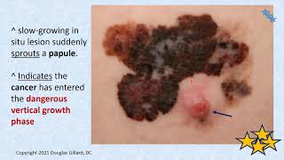 Dermatology wk6spr21 Malignant melanoma [upl. by Duvall816]