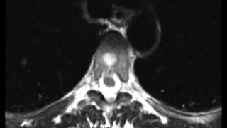 Typical and Atypical Hemangioma [upl. by Haonam]