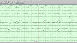 Left parasagittal epileptiform activity [upl. by Alidia]