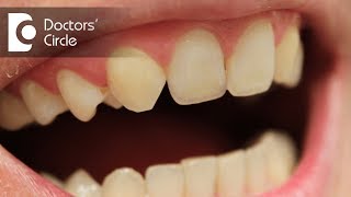 Everything about hypodontia  Dr Jayaprakash Ittigi [upl. by Bellanca958]