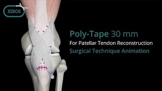 PolyTape for Patellar Tendon Reconstruction Surgical Technique Animation [upl. by Atteinotna]