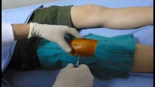 Knee aspiration technique Knee synovitis เจาะเข่า เข่าอักเสบ [upl. by Irolav579]