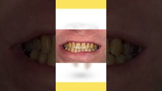 Yellow Teeth Home Remedies Yellow Teeth ko White Kaise Kare xarry shorts [upl. by Gabrielson]