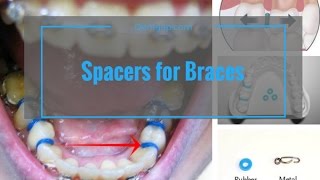 Spacer For Braces  Do They Hurt  Check Live View [upl. by Ettenoj514]