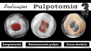 Quando indicar a Pulpotomia  Três pontos chaves a serem observados  HELDER FERNANDES [upl. by Baras]