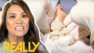 Dr Lees MOST INTENSE Cyst Removal Surgeries  Dr Pimple Popper [upl. by Nickolaus]