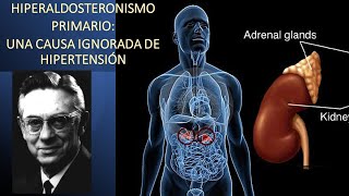 Hiperaldosteronismo primario una causa ignorada de hipertensión arterial [upl. by Gundry]