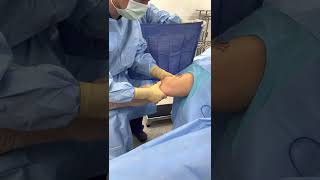 Preoperative Anterior Cruciate Ligament ACL Laxity After ACL Rupture [upl. by Aerdnuahs]