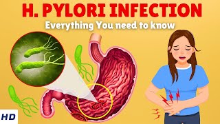 Helicobacter Pylori Infection – Causes Signs and Symptoms Diagnosis amp Treatment [upl. by Trillby]