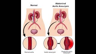 Aneurysm Symptoms and Causes  Diagnosis  Management and Treatment  Prevention healthcare [upl. by Tearle]