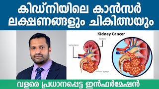 Renal Cell Carcinoma RCC  Symptoms Causes and Treatment  Dr Vishnu Gopal  Aster MIMS Kannur [upl. by Eiramyllek]