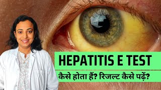 Hepatitis E Test Procedure Symptoms Infection Reasons and More [upl. by Manly]