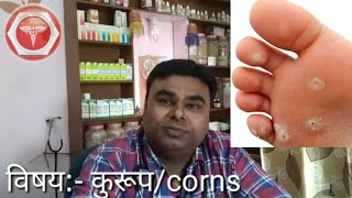 कुरूपगोखरू आहेत पायाला मग पहाचcorns treatment by Dr sachchidanand pardeshi [upl. by Johann651]