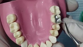 ازاى تعمل quotAmalgam restoration class I compound for upper 6 with matrix band [upl. by Merwyn]