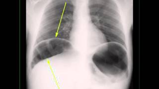 Interposition of colon under right Hemidiaphragm on X ray [upl. by Llerud]