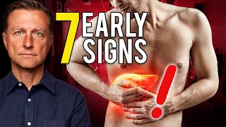 7 Early Signs of Liver Damage [upl. by Jarv]