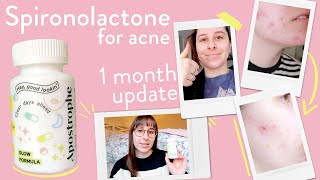 Spironolactone for acne month 1  its starting to work [upl. by Hobie]