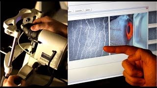 Corneal confocal microscopy image acquisition part 1 [upl. by Sidoney]