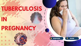 Tuberculosis in Pregnancy Causes Symptoms Diagnosis Treatment and Pathology  TOG Article [upl. by Solram]