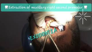 Buccal to lingual motion maxillary 2nd premolar extraction with double curvatures Sshaped roots [upl. by Soilisav]