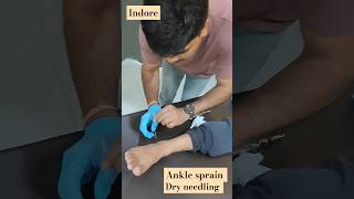 Ankle spraindry needlingankle pain treatmentmuscle painacupuncturepain reliefindore [upl. by Minnnie]