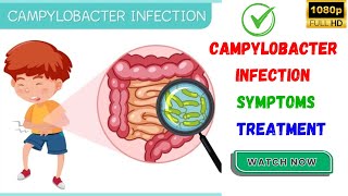 Campylobacter Infection Its Symptoms amp Possible Treatments  What Is Campylobacter Infection📢📢📢📢 [upl. by Laurie73]