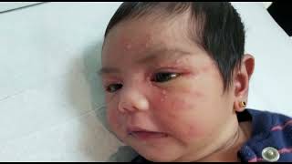 visual initial newborn assessment neonatal Acne cephalic pustulosis erythema toxicum pustular DD [upl. by Nadda]