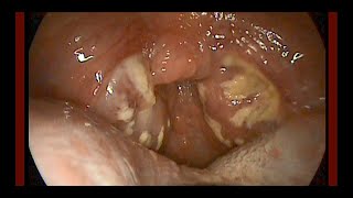 Acute Exudative Tonsillitis [upl. by Ahsit]