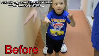 Before and After Cerebral Palsy Surgery  Case Example 1  Tovmed Medical Center [upl. by Namus731]