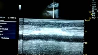 IVC m mode in an overloaded patient [upl. by Yrelav]