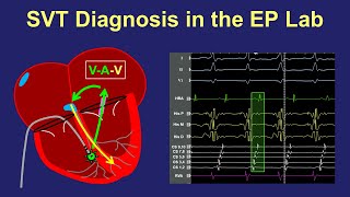 Diagnosis of SVT in the EP lab [upl. by Tartan]