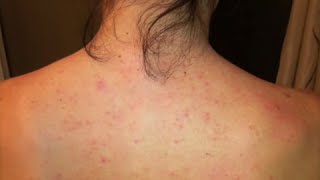 Dayna’s Story Improvement with Folliculitis or “Back Acne” [upl. by Adnat443]