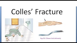 Orthopedics 130 Colles fracture Dorsal tilt Complications Dinner fork deformity Darrack Sudeck [upl. by Enialem404]