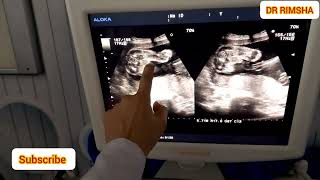 posterior placenta and baby boyBaby boy on ultrasound Radiology by DrRimsha [upl. by Nrubliw]