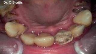 Gum Disease Rotten Teeth [upl. by Bena]