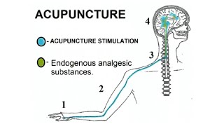 ACUPUNCTURE ANALGESIA Acupuncture and TCM [upl. by Kamerman159]