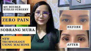 My double eyelid surgery experience  New technology  Plasma  Philippines [upl. by Adallard]