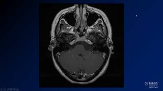 Neuroradiology board review lecture 1 case 17 [upl. by Atinal536]