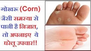 कॉर्न कील गोखरू का इलाज Corn Removal Home Remedies Corn Home TreatmentCorn ka Gharelu Ilaj Gokhru [upl. by Previdi565]