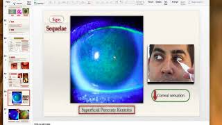 Viral keratitis [upl. by Walcott]