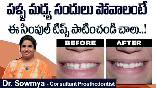 పళ్ళ మధ్య ఖాళీ ఉందా How to Close Gap Between Teeth  Teeth Gap Treatment  Eledent Dental Hospitals [upl. by Desdemona]