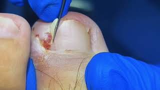 You Wont Believe This Huge Ingrown Toenail Removal [upl. by Marielle]