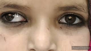 Intermittent exotropia decompensated [upl. by Lash]