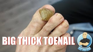 HOW TO TREAT YOUR BIG THICK RAMS HORN TOENAIL  FOOT HEALTH MONTH 2018 14 [upl. by Cleodal]