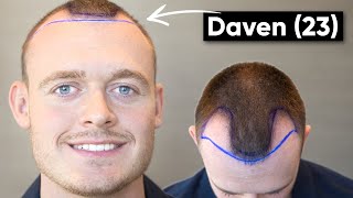 Geheimratsecken mit 23 Jahren  Davens Haartransplantation im Memorial [upl. by Leinahtam]