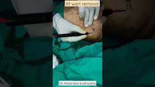 radiofrequency wart removalgenital wart condyloma shorts [upl. by Schach]