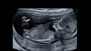 Ectopia cordis in Antenatal scan [upl. by Iy]